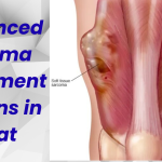 Advanced Sarcoma Treatment Options in Gujarat 2
